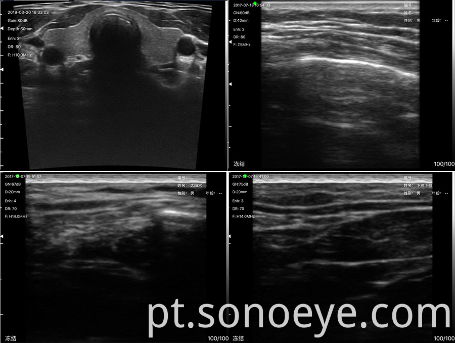 porket ultrasound